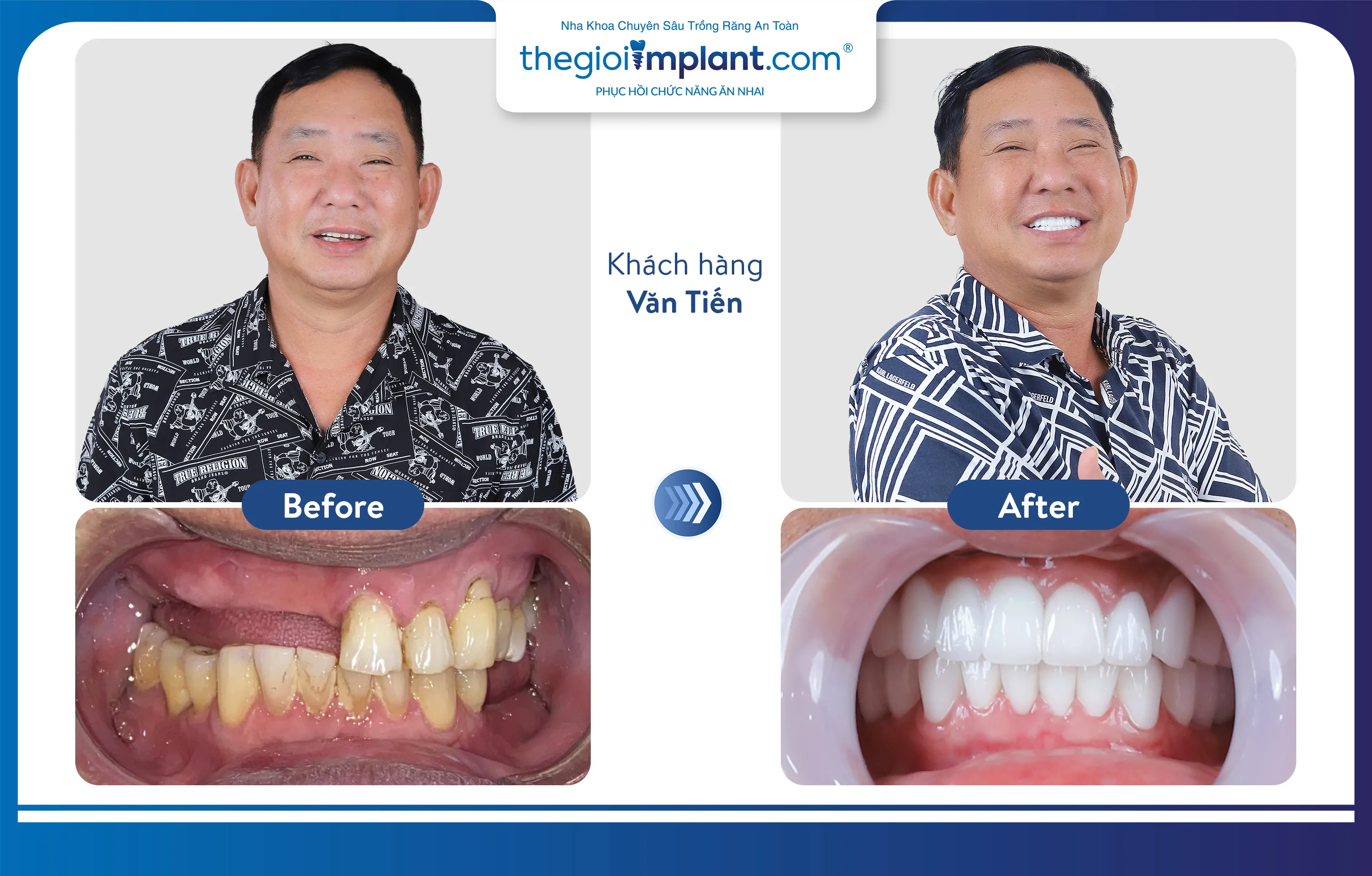 VTV1 ĐƯA TIN: NHA KHOA THẾ GIỚI IMPLANT.COM TRỒNG RĂNG AN TOÀN, BỀN VỮNG VỚI MÁNG ĐỊNH VỊ DSG