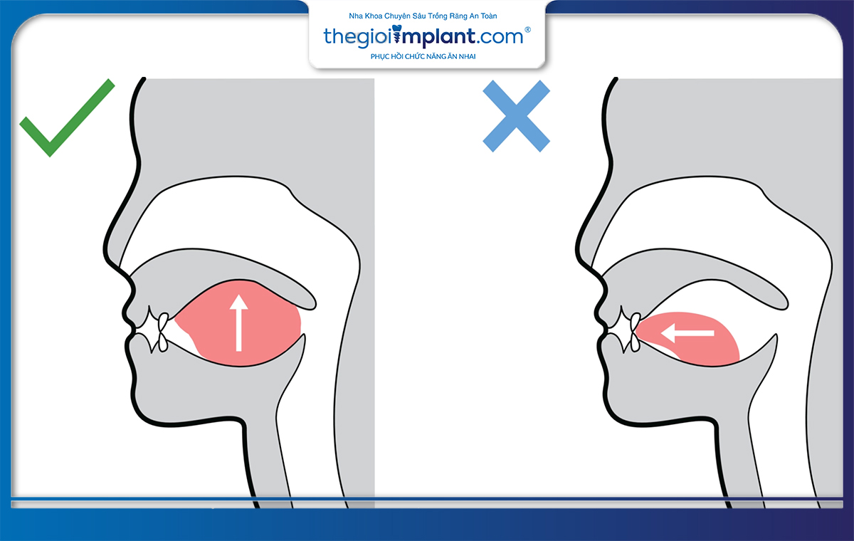 Lưỡi đẩy vào răng cửa trên là lỗi sai thường gặp nhất