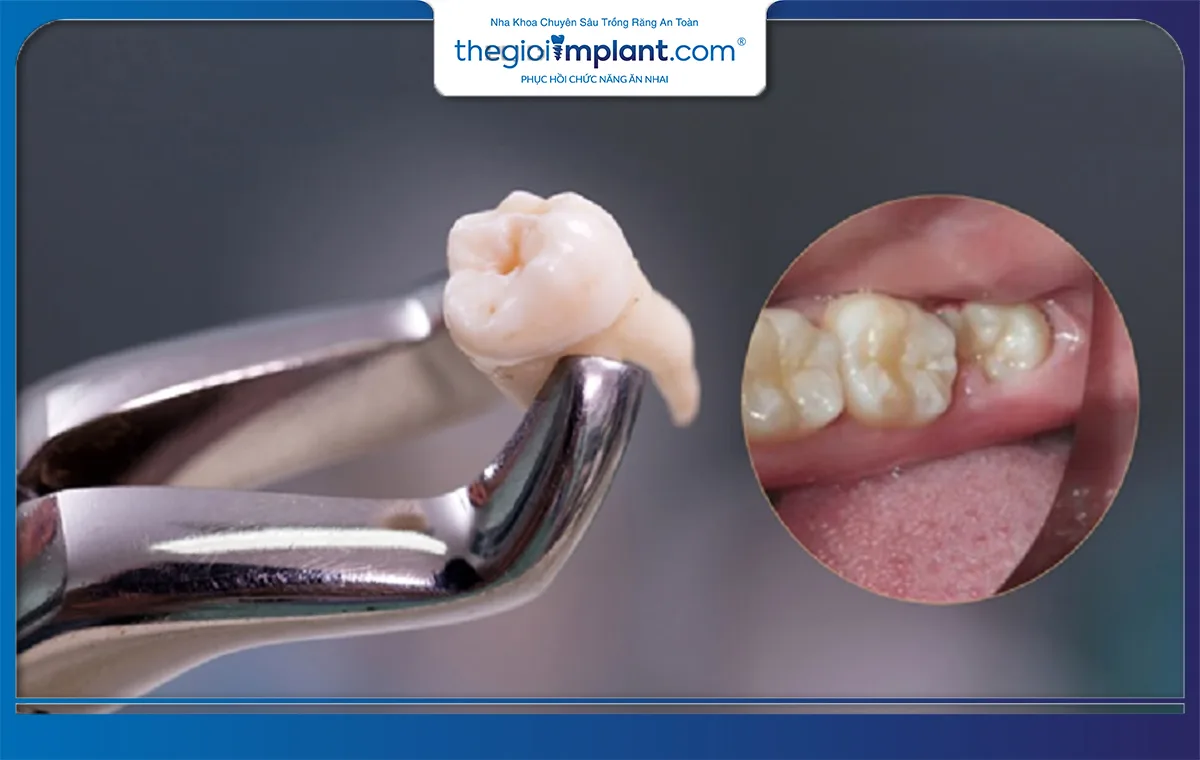 Răng khôn mọc sẽ mang lại rất nhiều phiền phức