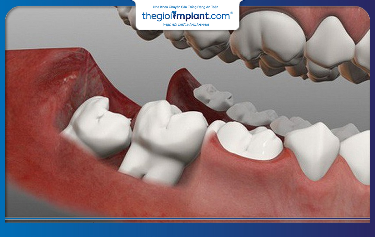 Răng khôn mọc sai lệch bất thường cần phải loại bỏ ngay