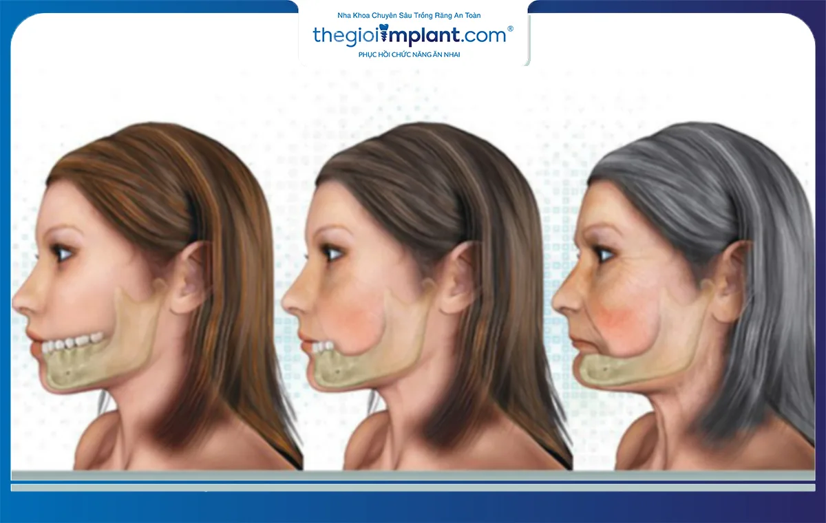 Tiêu xương hàm nếu không xử lý sẽ khiến má bị hóp