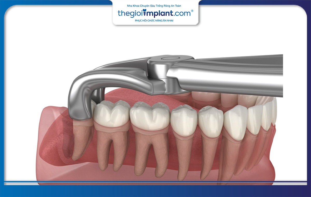 Nhịn ăn trước khi nhổ răng sẽ giúp bạn tránh các rủi ro mà thuốc tê mang lại