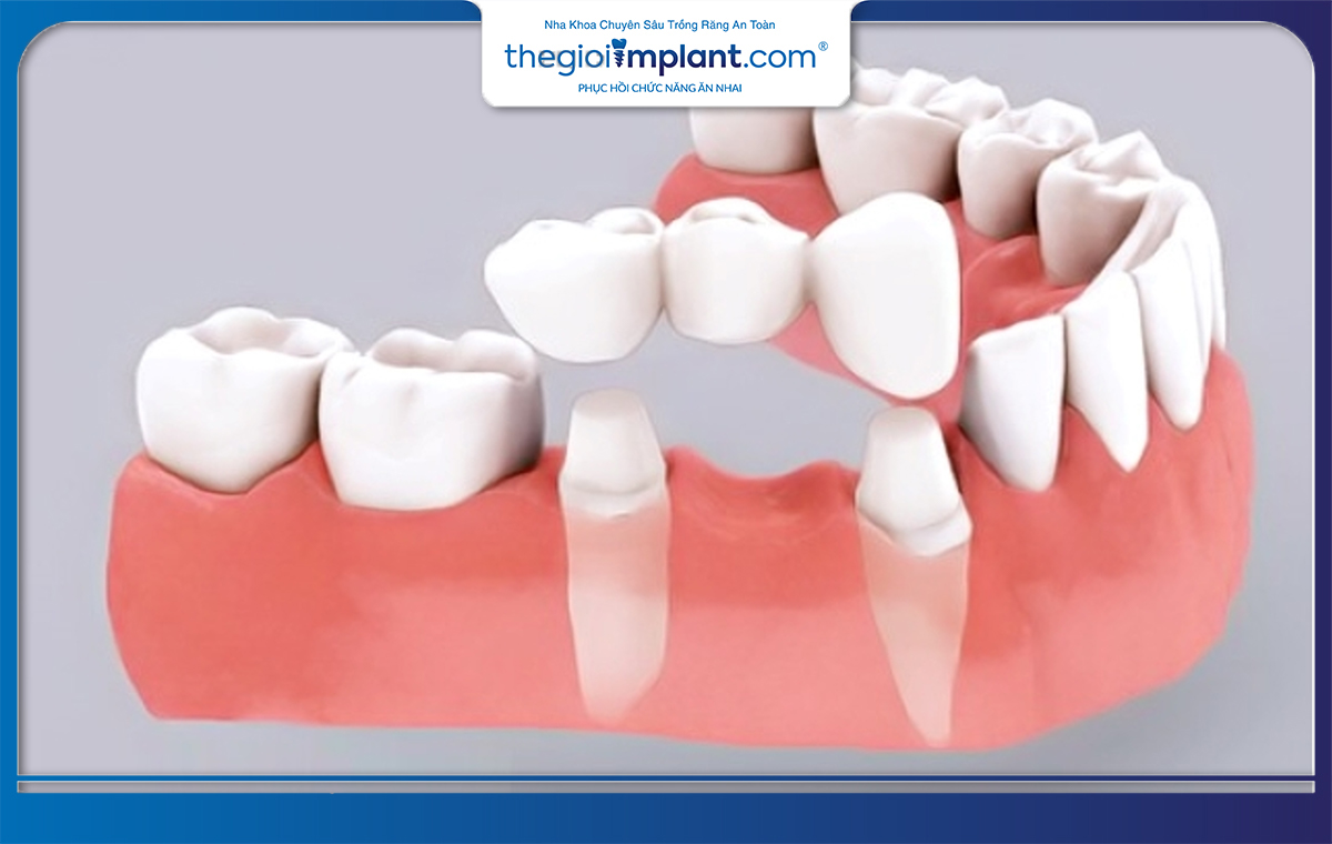 Trồng răng giả tháo lắp là một trong những phương pháp dễ thực hiện