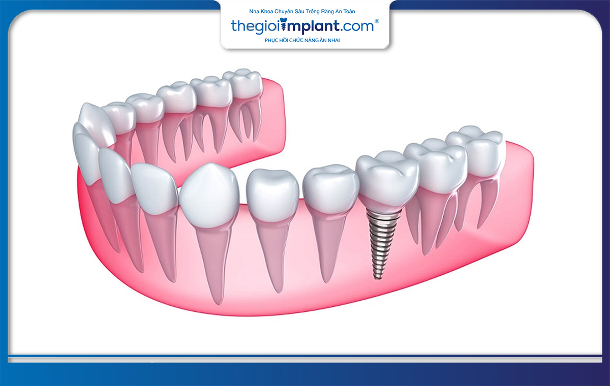 Cấy ghép implant là một trong những phương pháp phục hình răng tiên tiến nhất