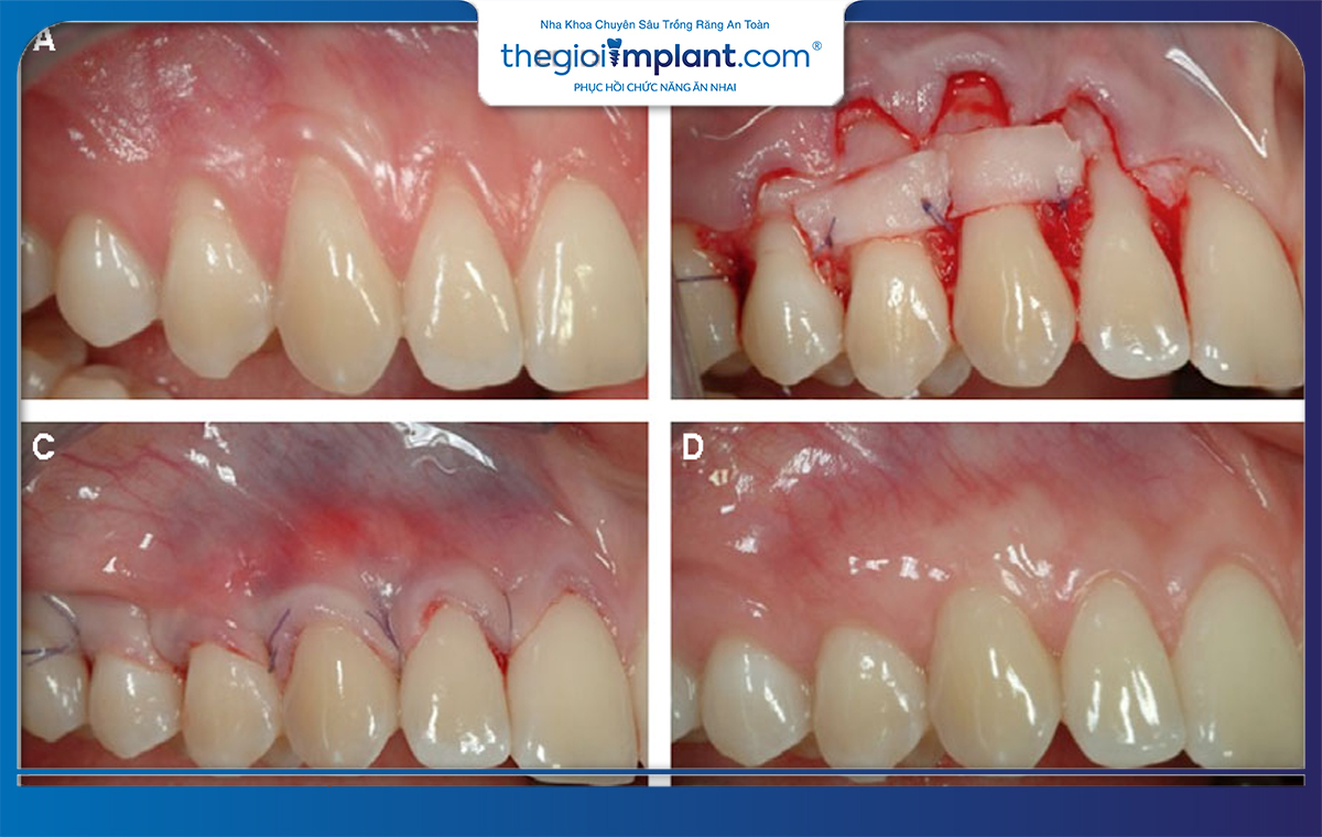 Khắc phục hở nướu răng mức độ nặng bằng thủ thuật ngoại khoa