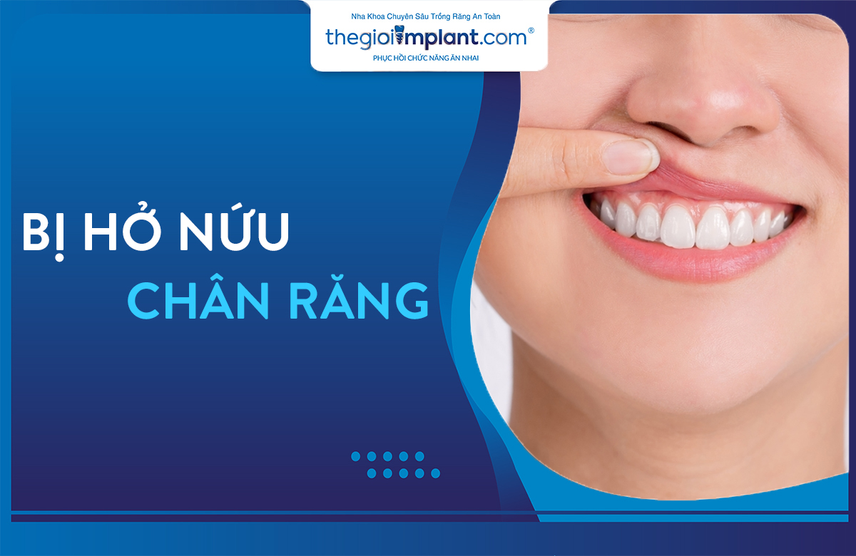 hở nứu chân răng thumbnail