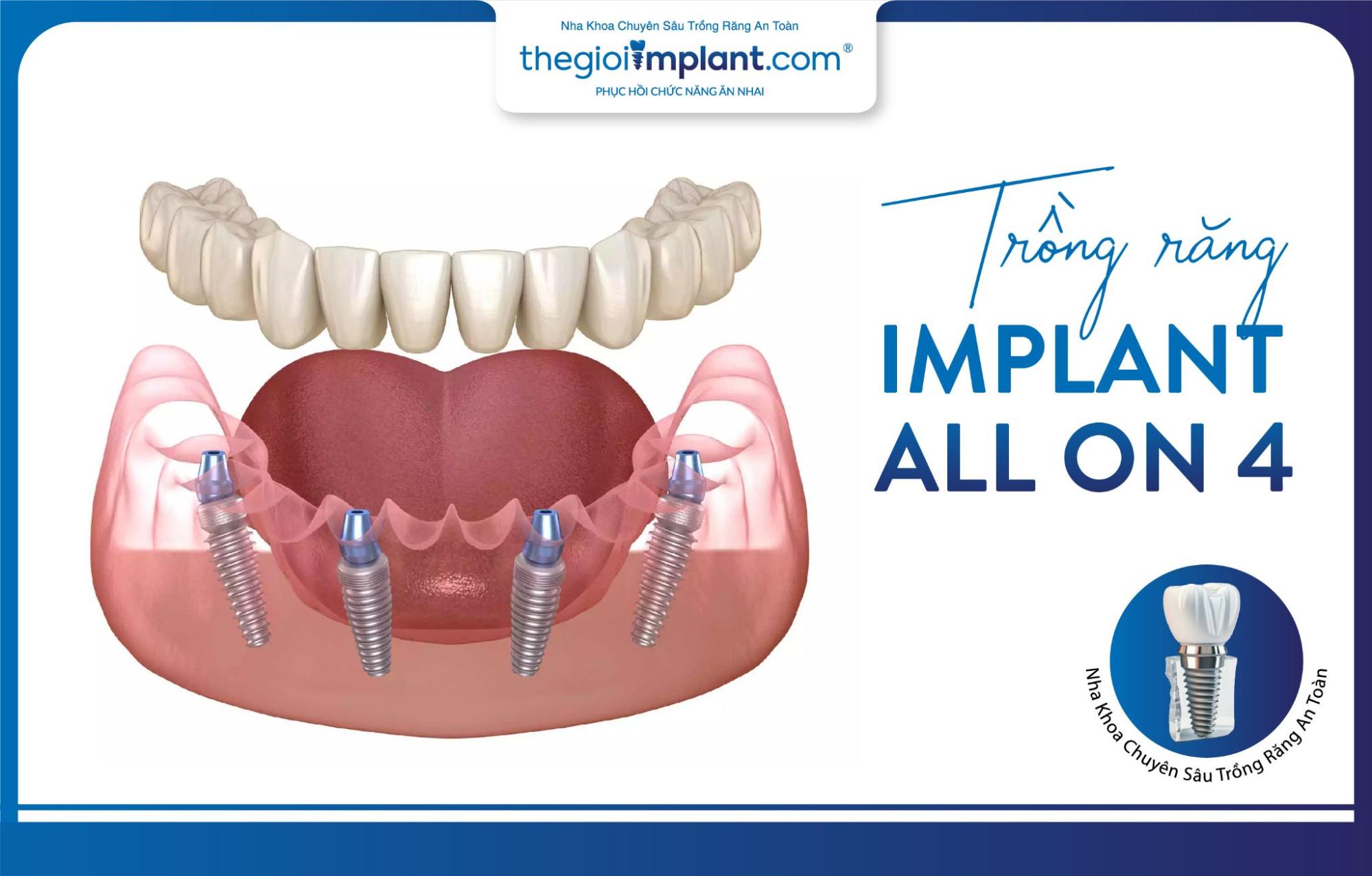 Chỉ với 4 trụ implant/ hàm đã có thể giúp người bệnh phục hình răng hiệu quả