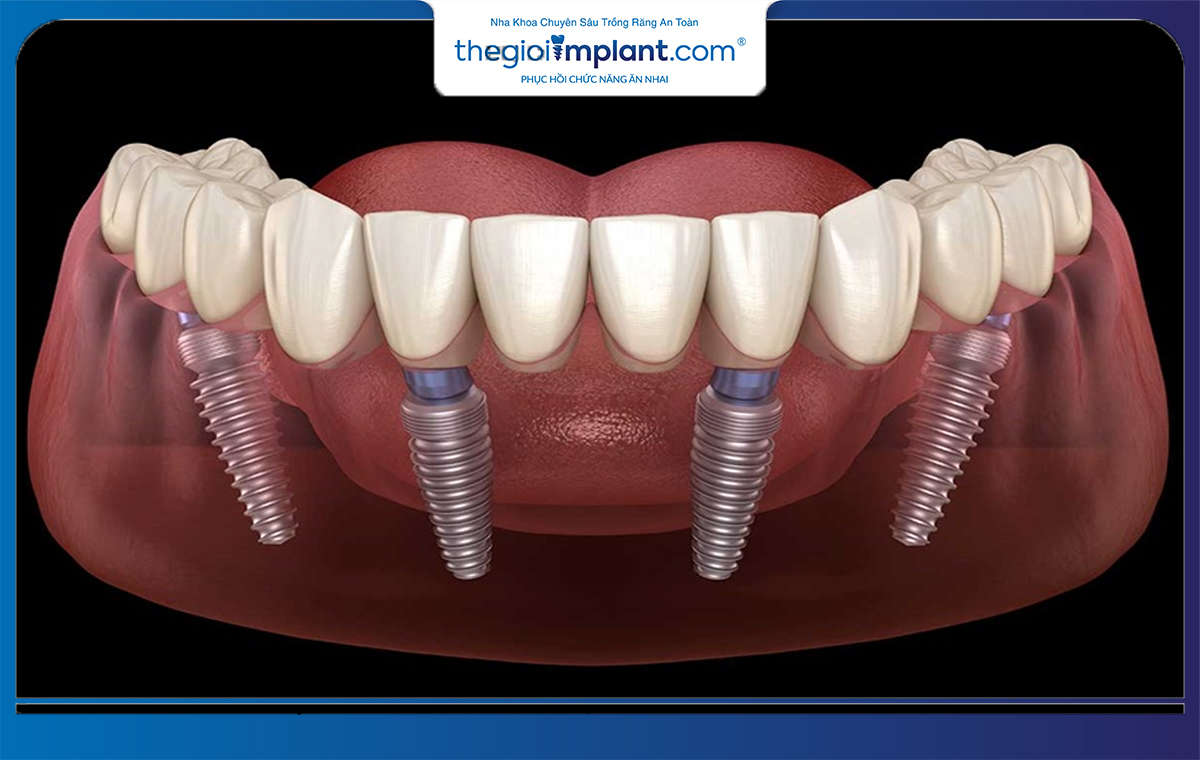 Trồng răng implant All On 4 mang đến nhiều ưu điểm