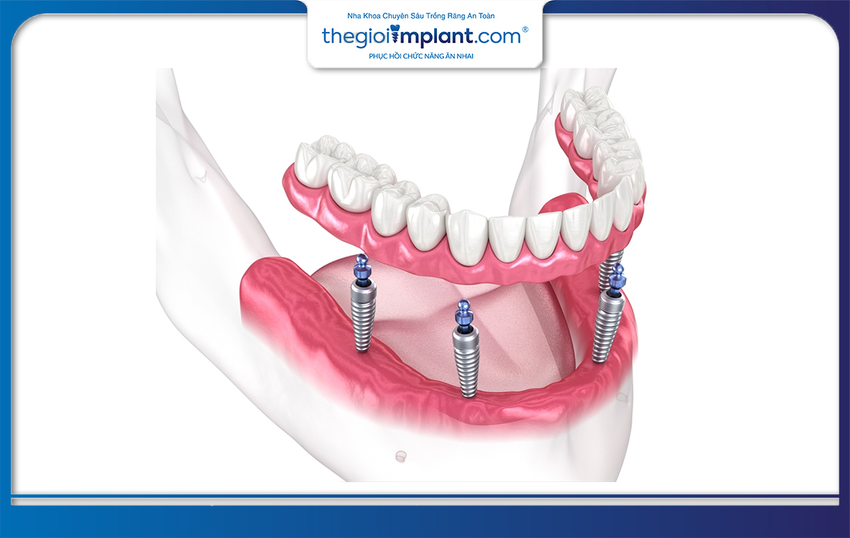 Kỹ thuật trồng răng implant All On 4 đòi hỏi bác sĩ phải có tay nghề chuyên môn cao