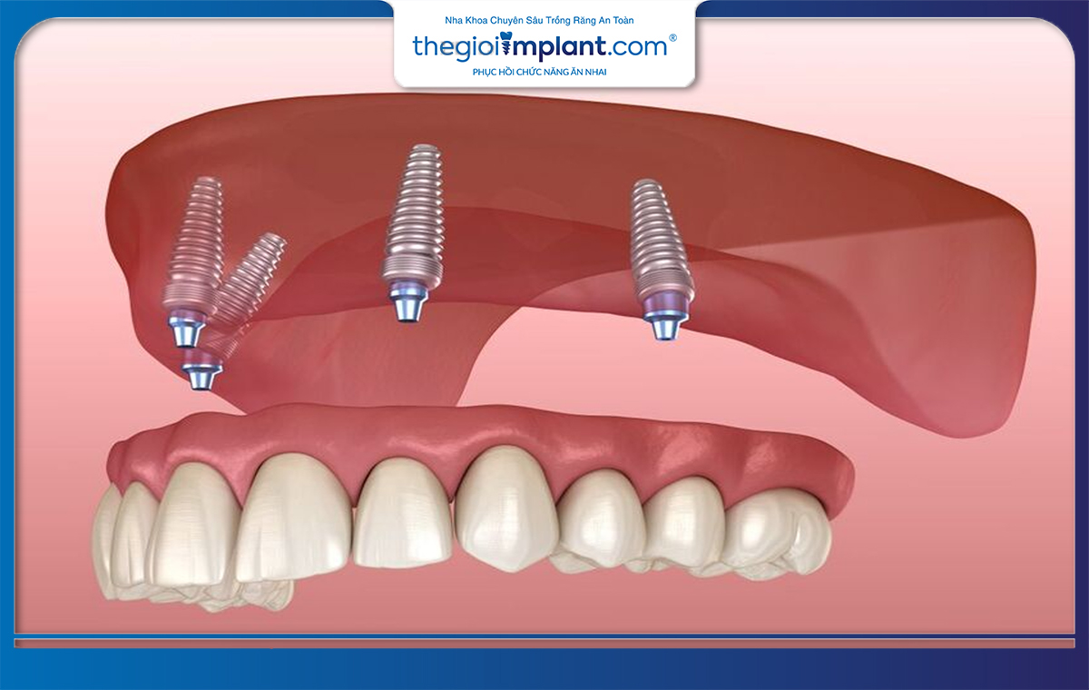 Implant All On 4 phù hợp cho cả những người cao tuổi mất răng lâu năm