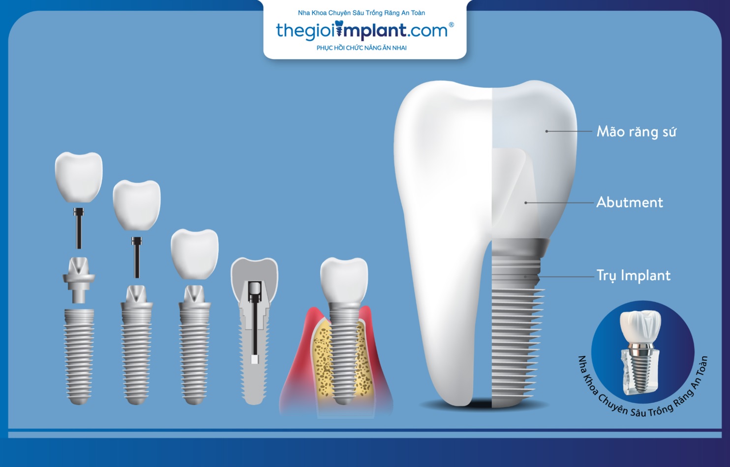 Chi phí trồng răng implant All On 4 phụ thuộc vào nhiều yếu tố