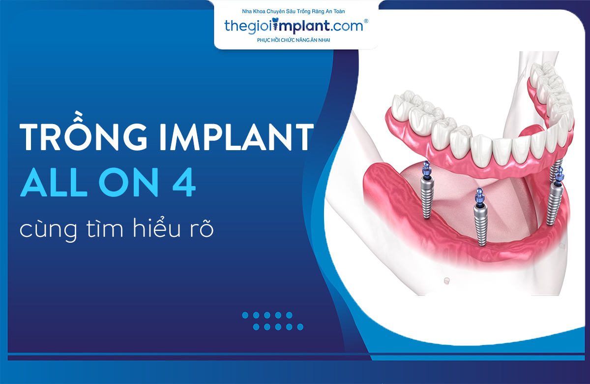 implant all on 4 thumbnail