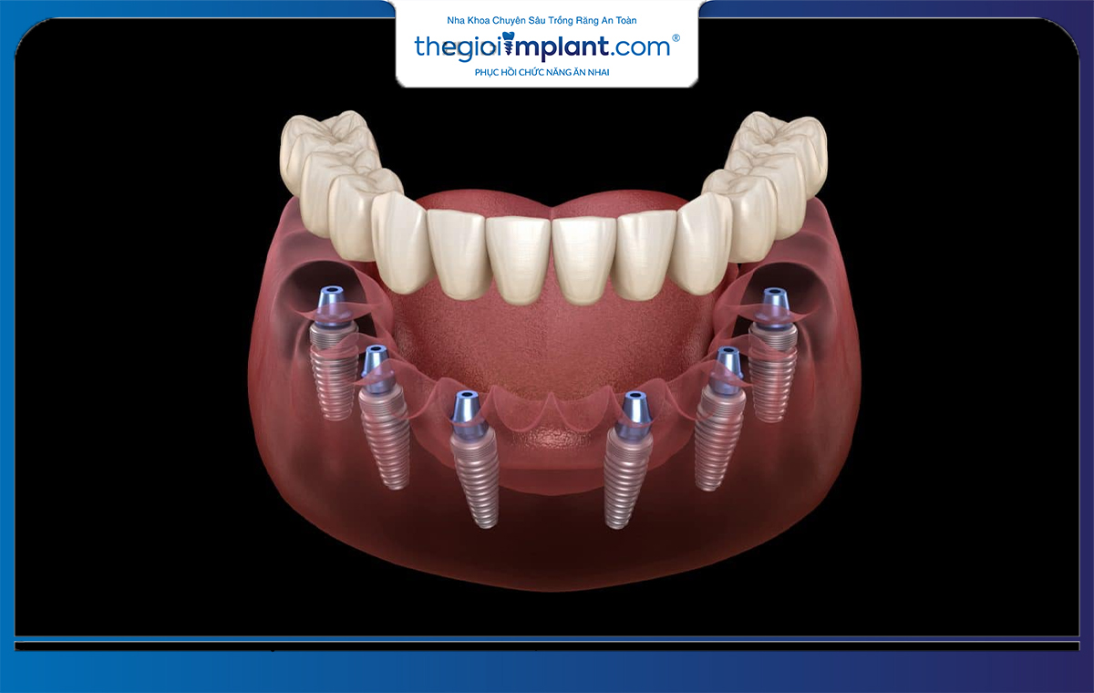 Với 6 trụ implant, bệnh nhân sẽ có thể khôi phục chức năng ăn nhai toàn hàm