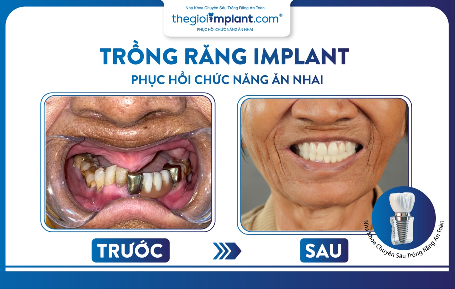 Implant All On 6 giúp phục hình triệt để, mang lại nụ cười tự tin