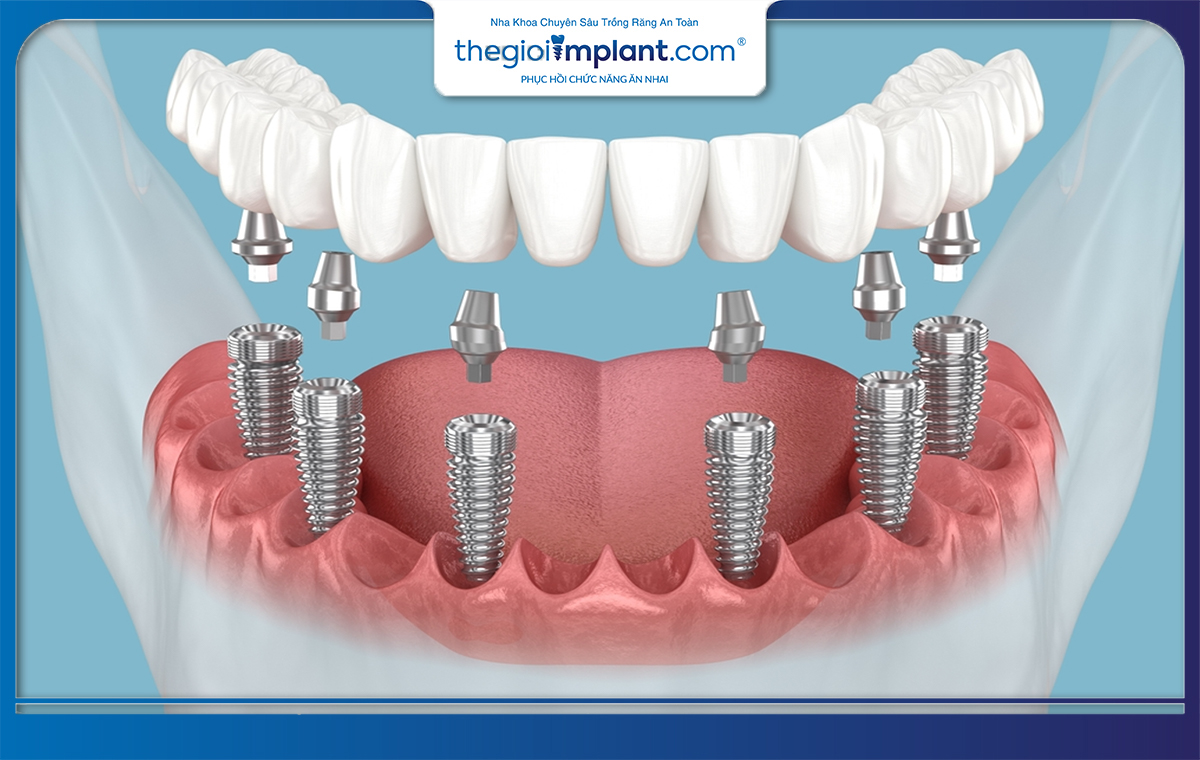 Số lượng trụ implant cần sử dụng ở phương pháp này là không nhỏ