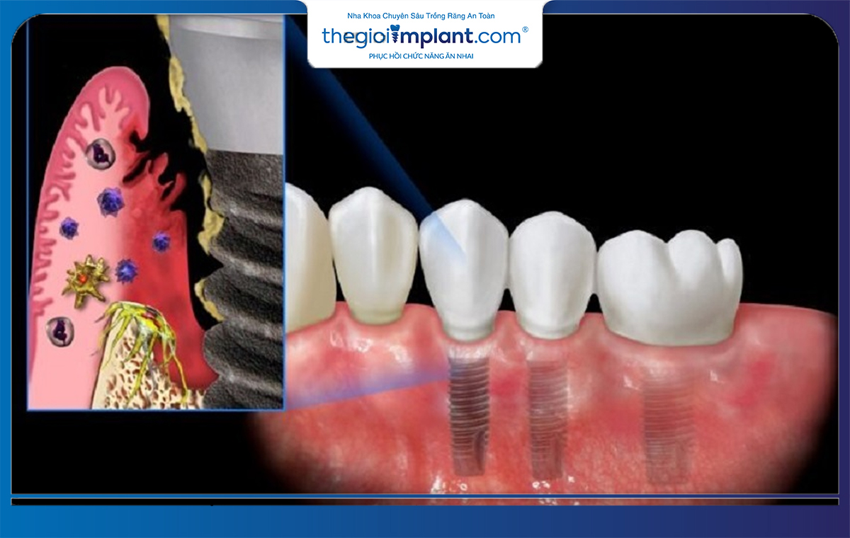 Một quy trình trồng răng implant thiếu chuẩn chỉnh là nguyên nhân khiến vi khuẩn xâm nhập gây nhiễm trùng