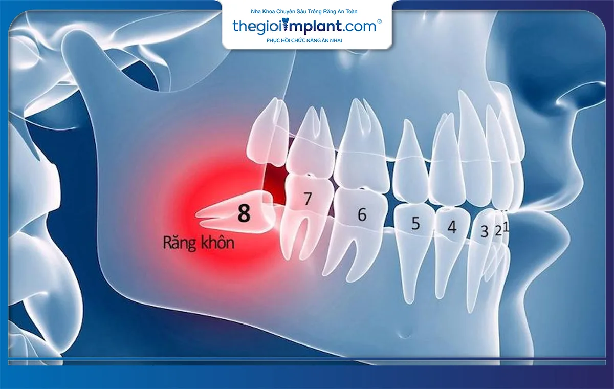 Răng khôn mọc muộn buộc phải nhổ bỏ là một trong những nguyên nhân làm cho người chỉ có 29 chiếc răng