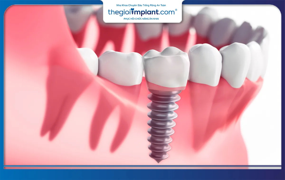Trồng răng implant