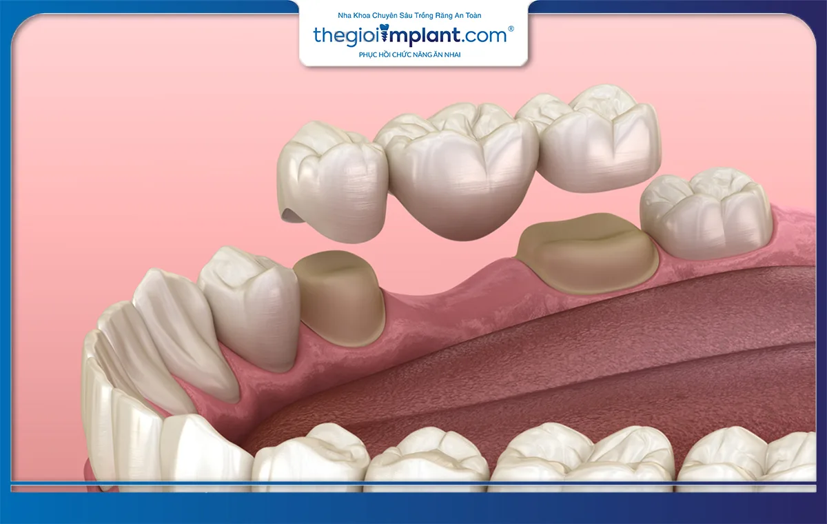 Cầu răng sứ là phương pháp phục hình răng nhanh chóng, dễ thực hiện