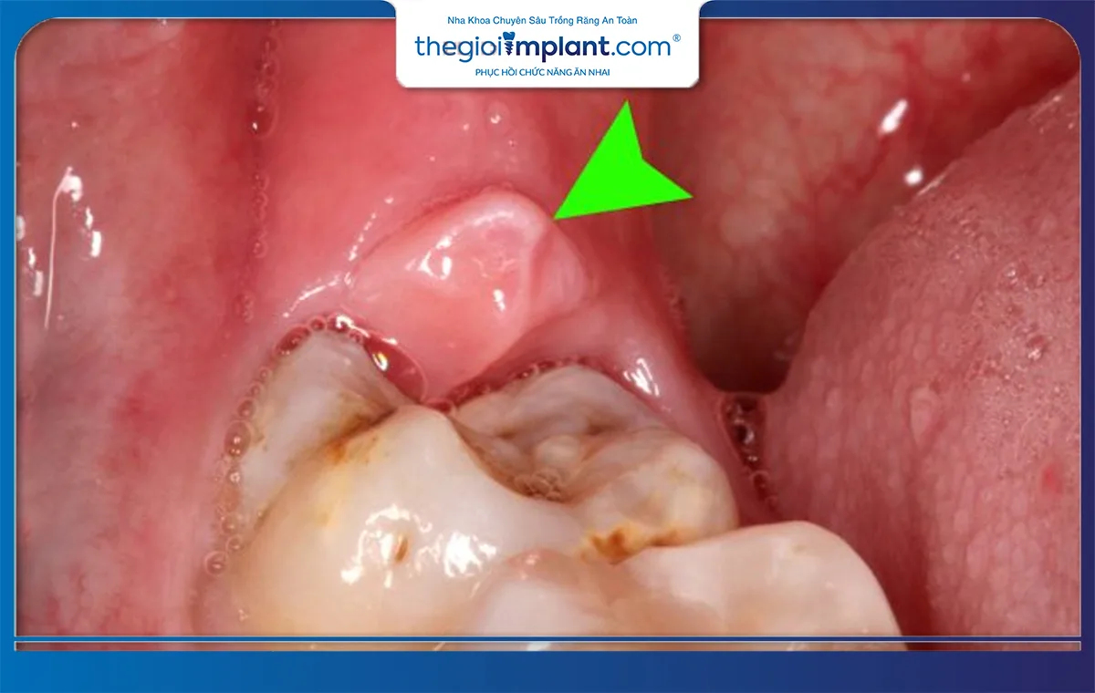 Răng khôn mọc không đúng vị trí có thể gây viêm lợi trùm