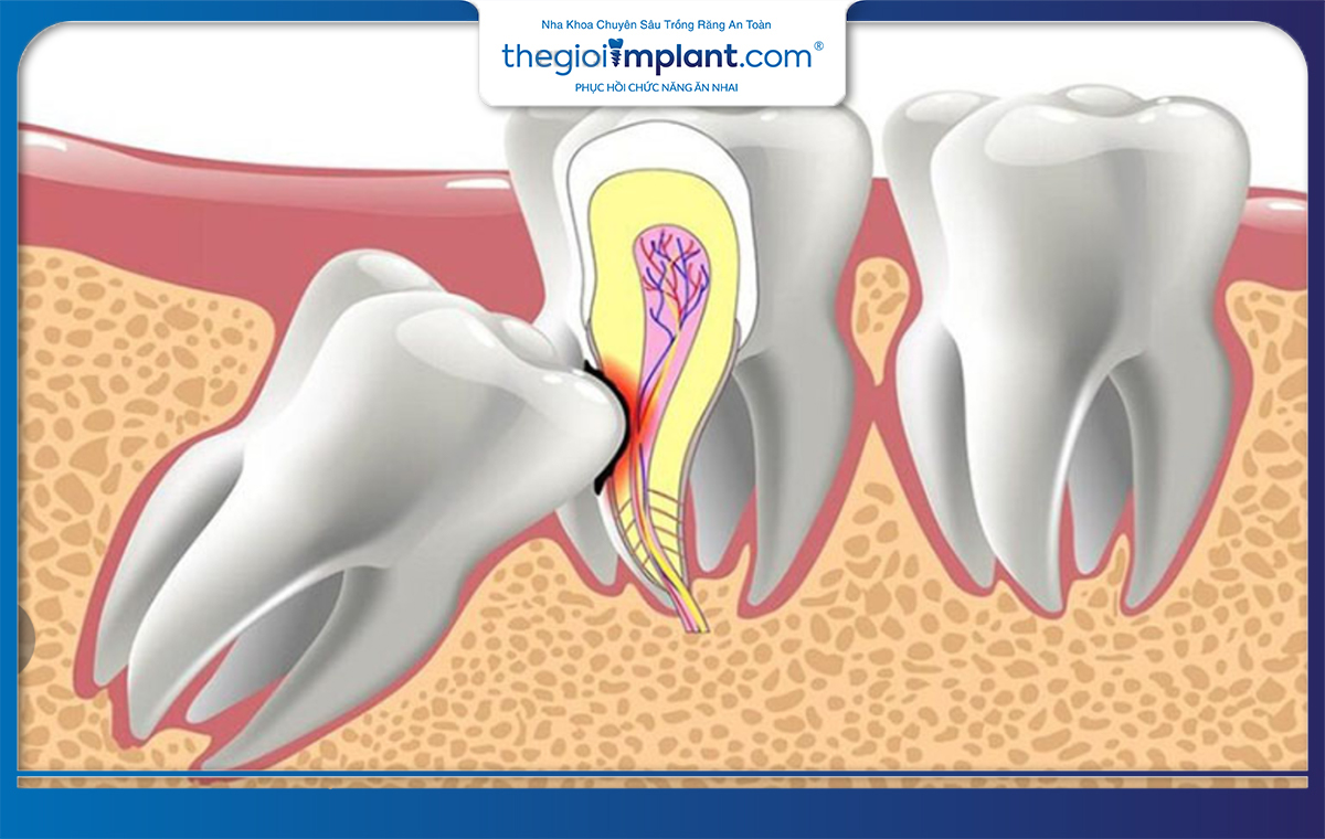 Răng khôn mọc sai vị trí có thể gây đau và sâu răng lân cận