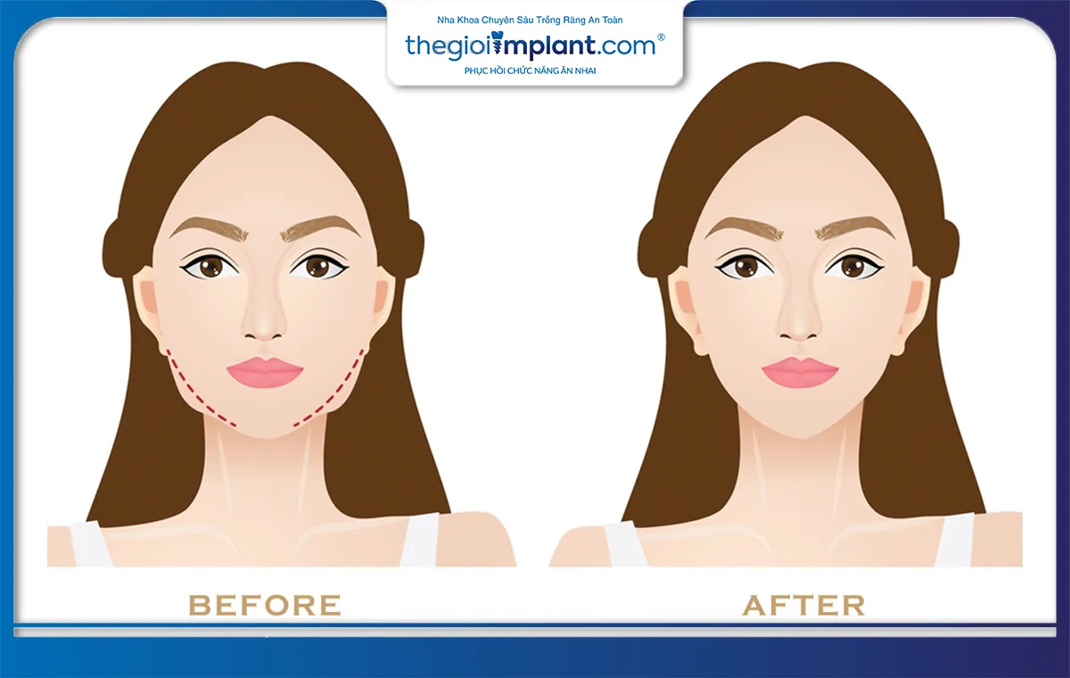 Nhổ răng khôn có thể thay đổi khuôn mặt ở một số trường hợp
