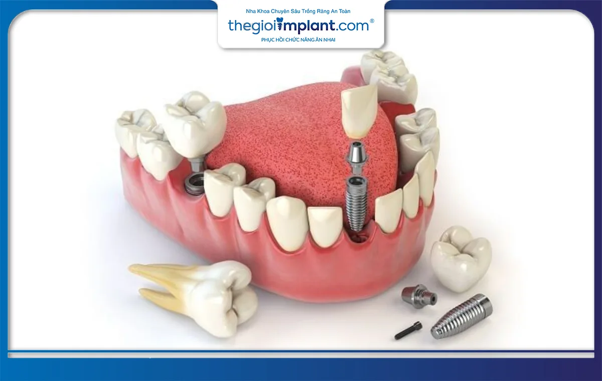 Trồng răng cho người già bằng phương pháp cấy ghép Implant đem lại chất lượng cao nhất