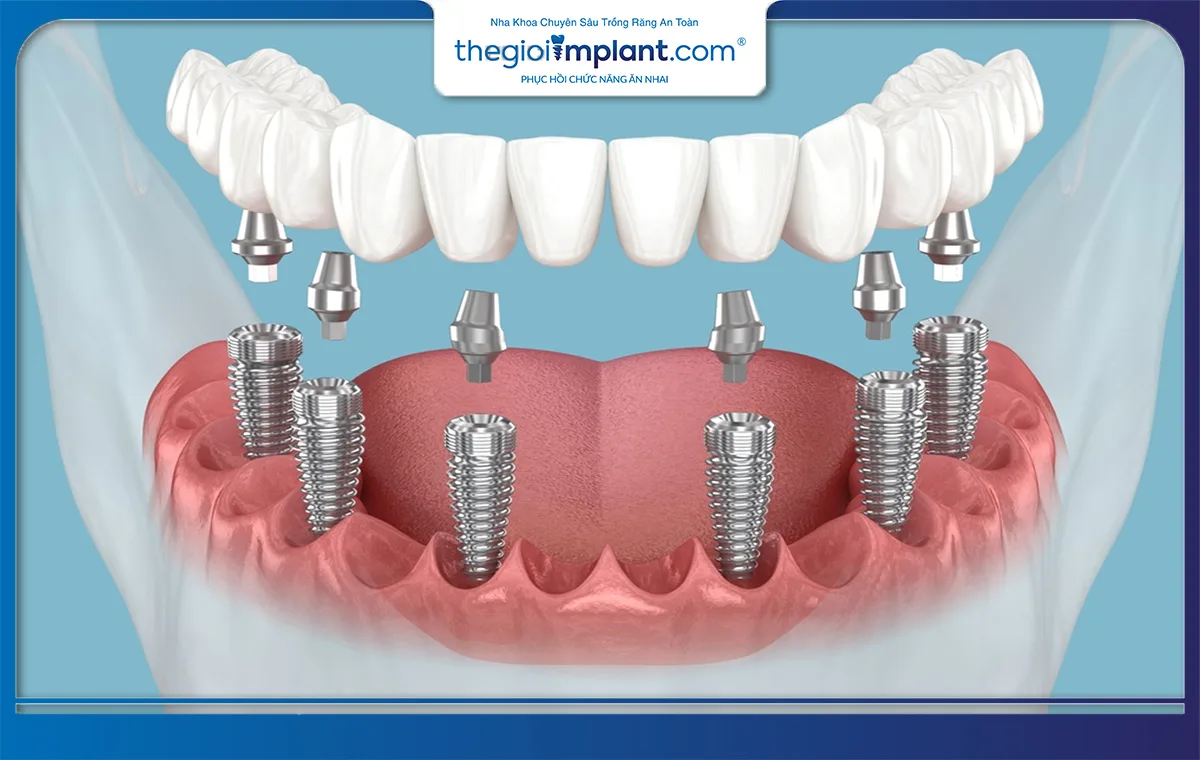 Số lượng trụ implant cần sử dụng ở phương pháp trồng răng implant all on 6 là không nhỏ