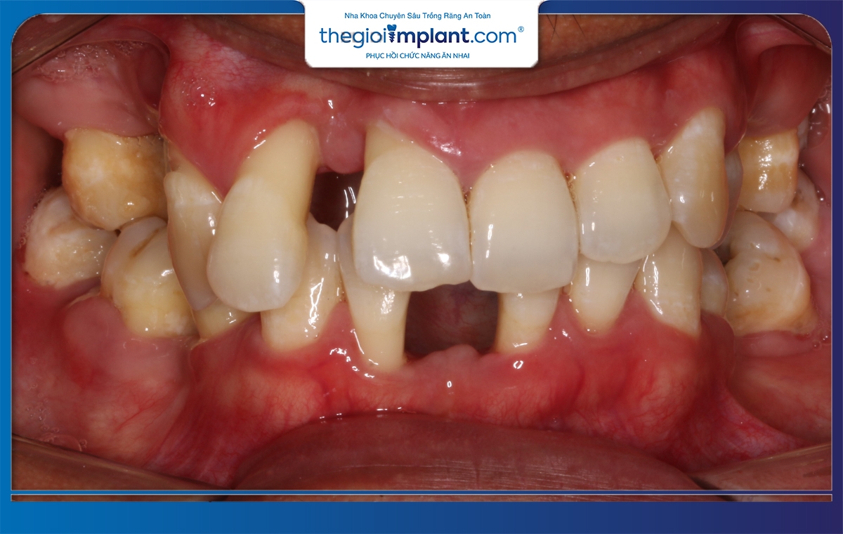 Tình trạng xương hàm là một yếu tố quan trọng quyết định bảng giá trồng răng Implant