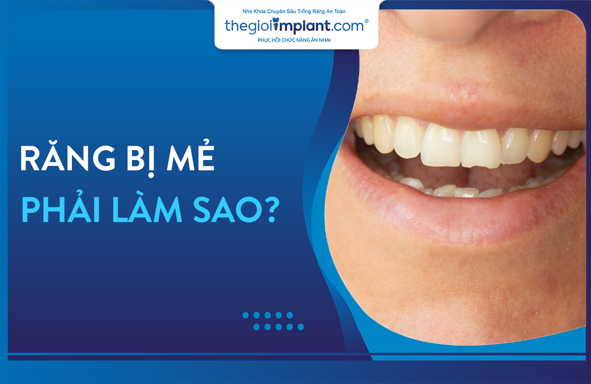 răng bị mẻ phải làm sao thumbnail