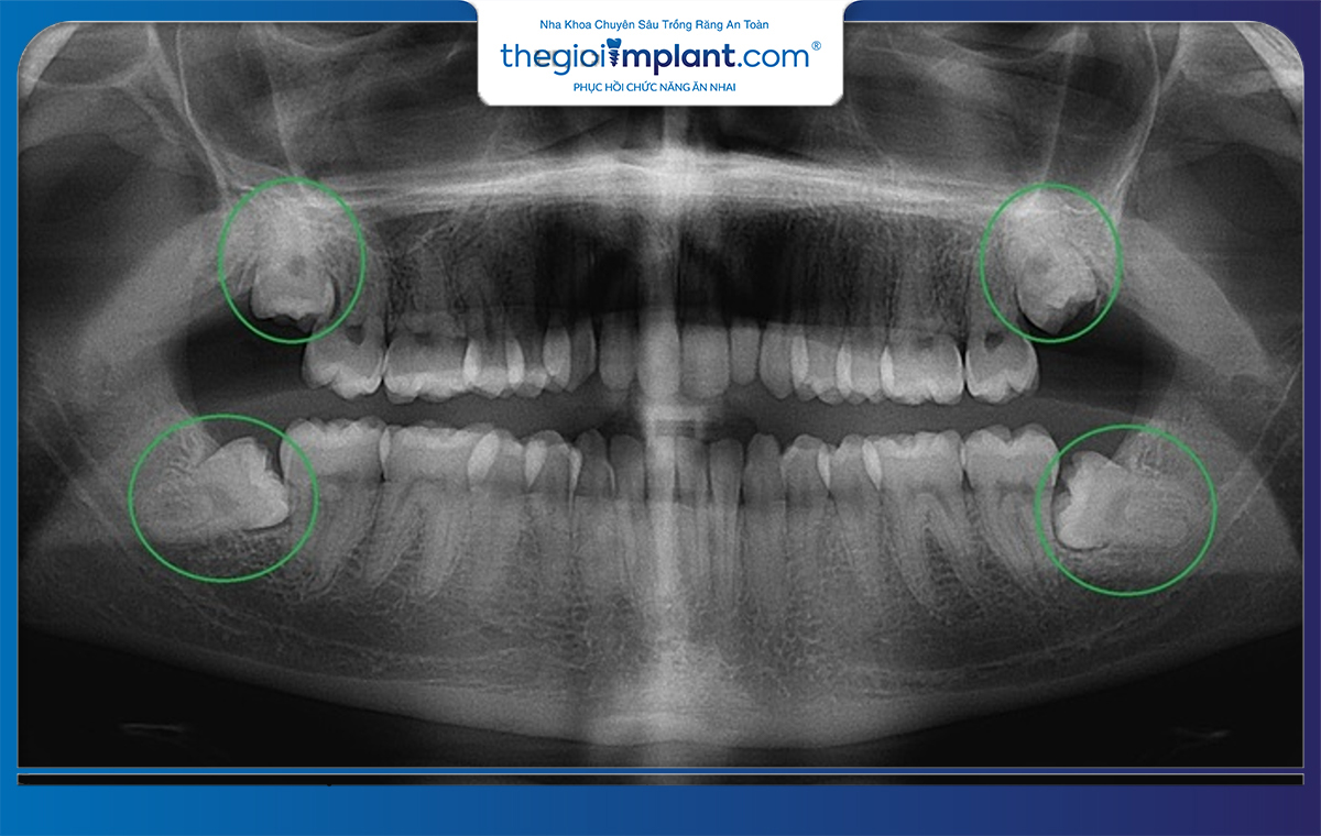 Bác sĩ có thể chụp panorama để đánh giá tình trạng răng khôn