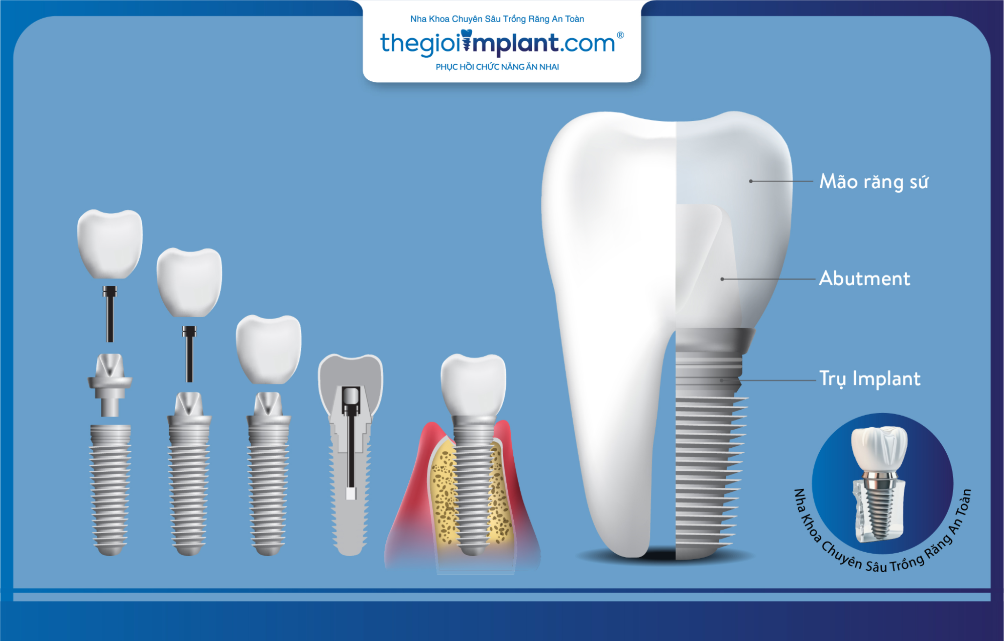 Nha khoa thegioiimplant.com cam kết chỉ sử dụng các loại trụ implant chính hãng chất lượng cao