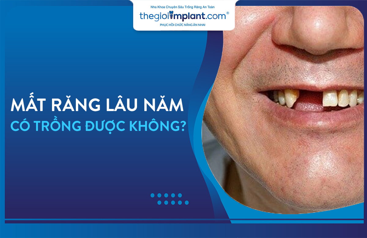 mất răng lâu năm có trồng được không thumbnail