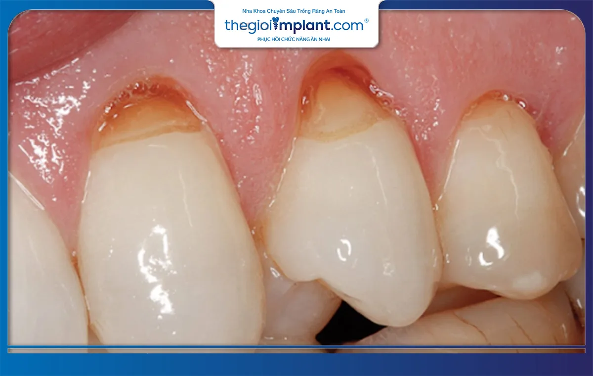 Mòn cổ chân răng là tình trạng lớp men răng bị mất đi