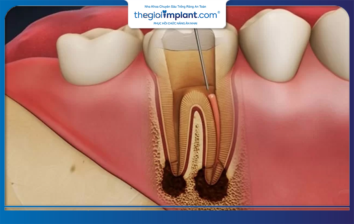 Điều trị tủy răng có giá thành khá dễ chịu 