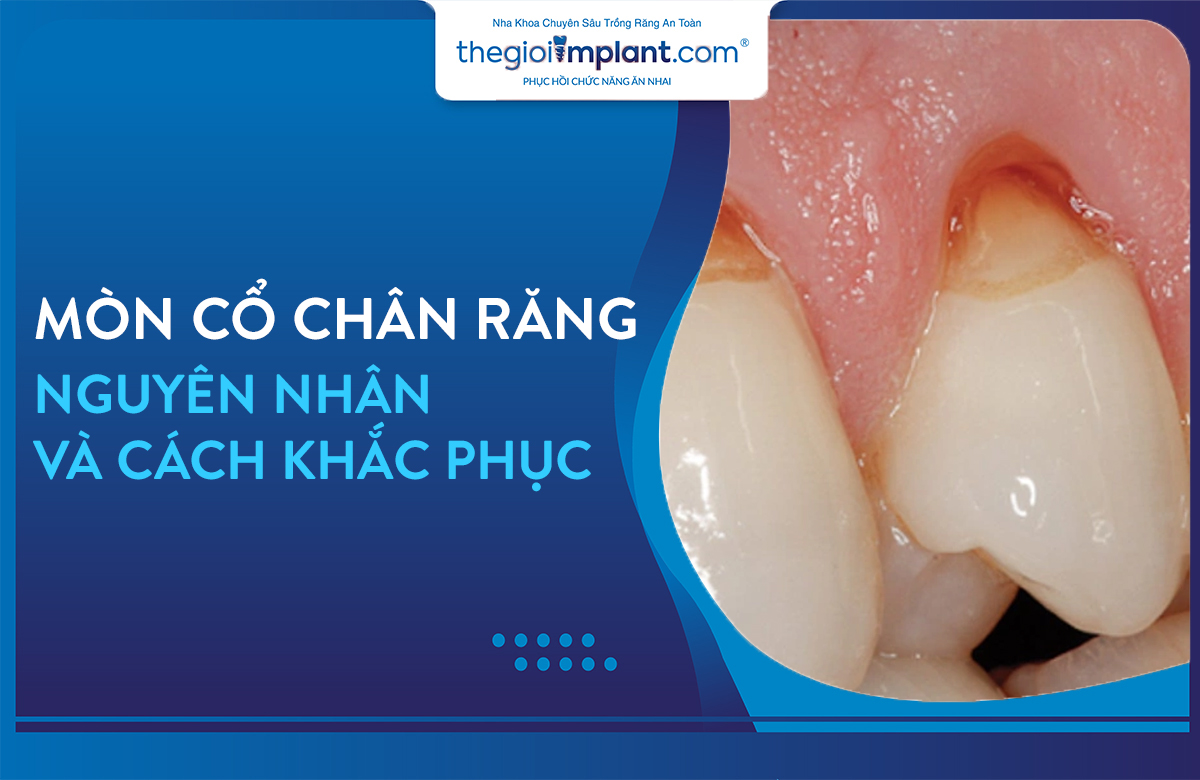 mòn cổ chân răng thumbnail