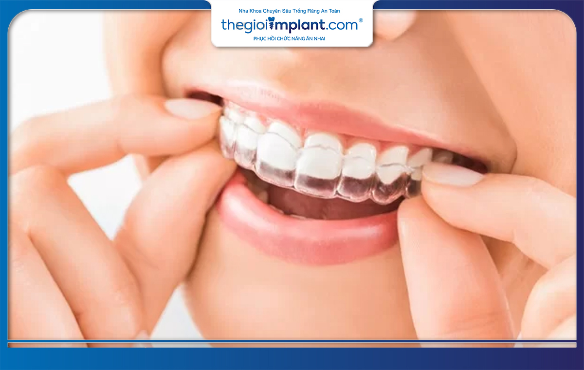 Niềng răng trong suốt (Invisalign)