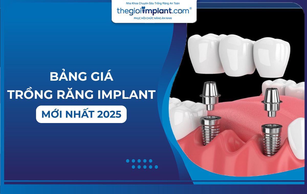 Bảng giá trồng răng implant trọn gói chuẩn y khoa năm 2025