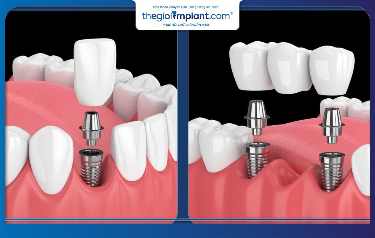 Tìm hiểu bảng giá trồng răng implant chuẩn y khoa tại Thegioiimplant.com