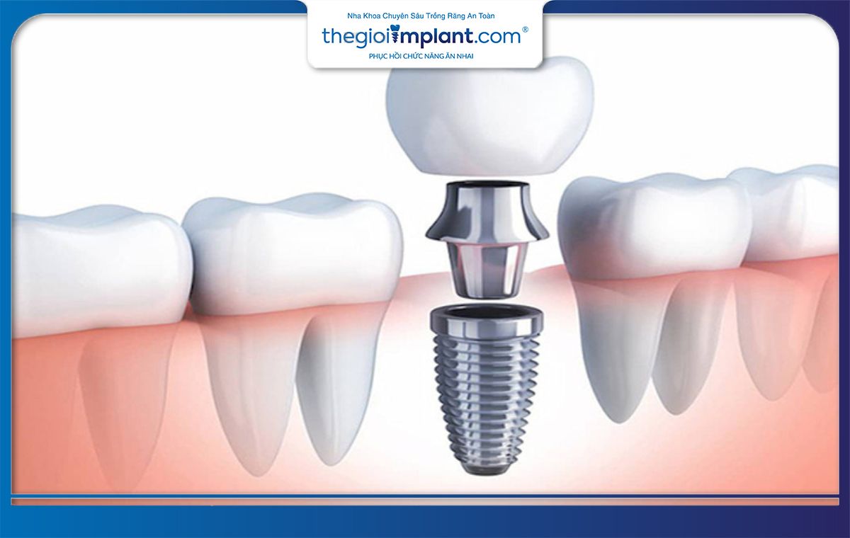 Lựa chọn trụ implant phù hợp giúp tiết kiệm chi phí hiệu quả