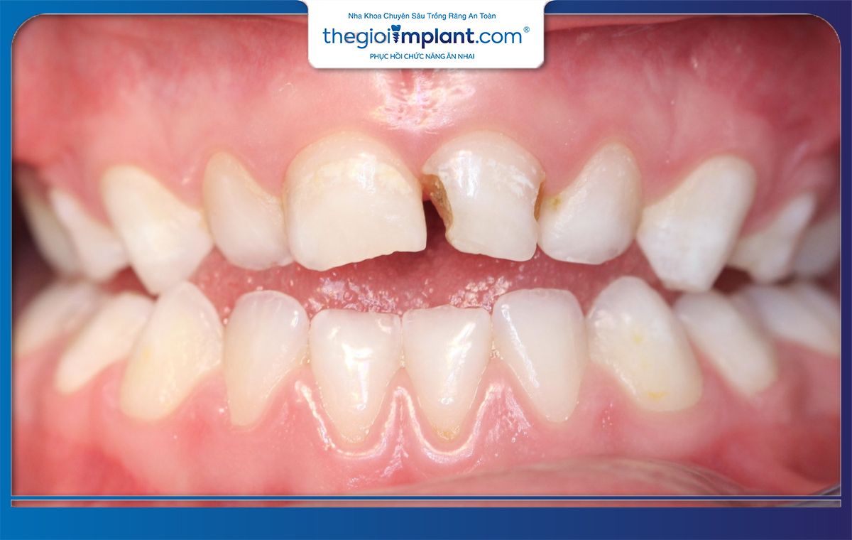 Tình trạng xương hàm là một yếu tố quan trọng quyết định bảng giá trồng răng implant