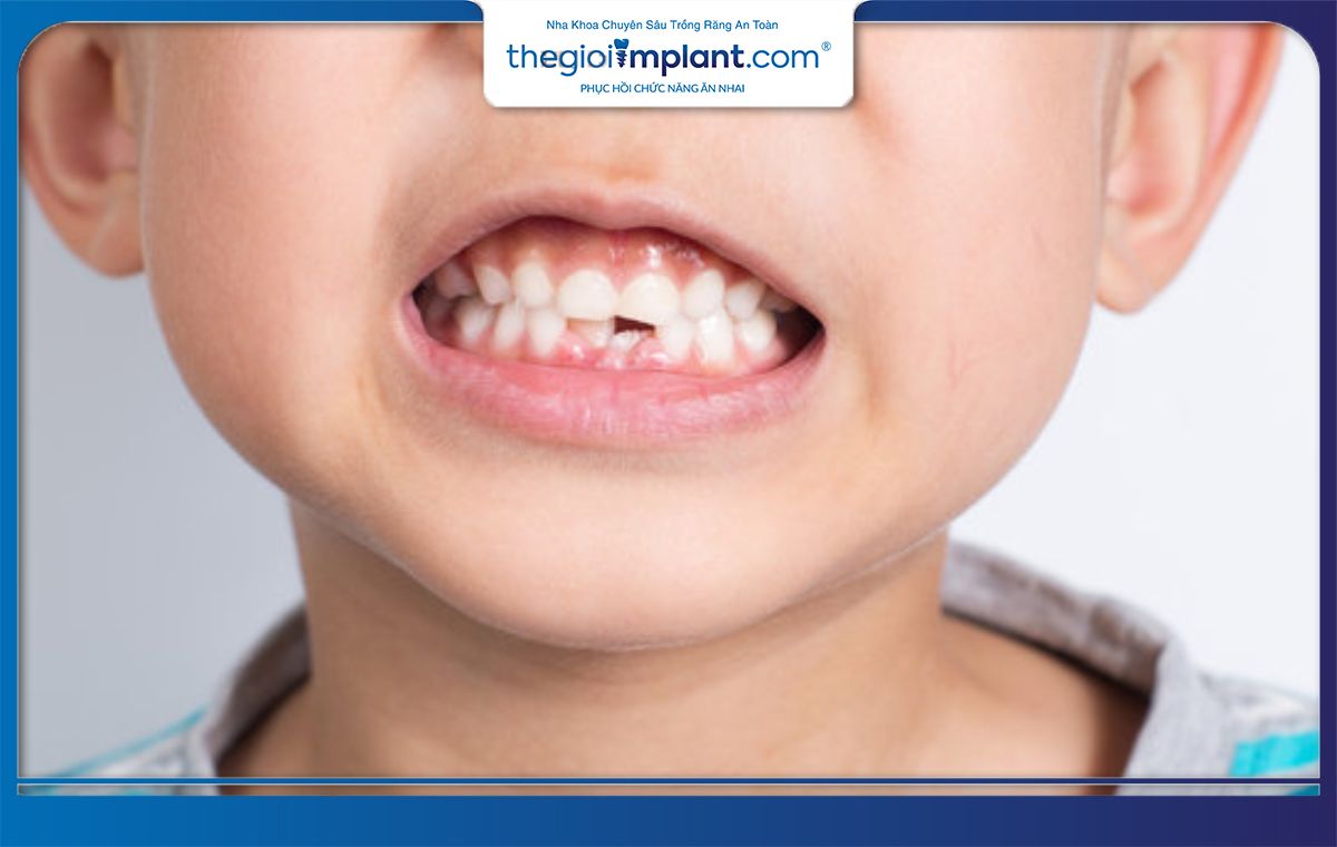 Trẻ em bao nhiêu tuổi thì trồng răng Implant được?