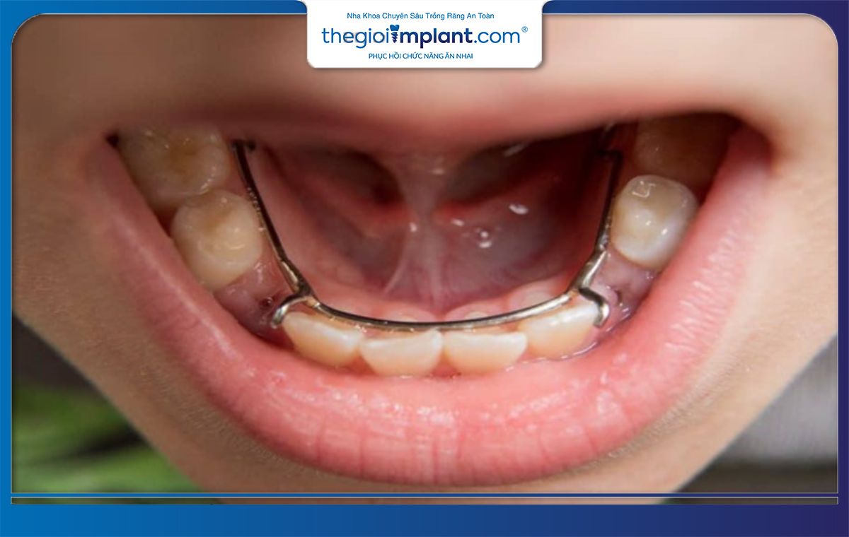 Hàm giữ khoảng - giải pháp cho trẻ em chưa thể trồng răng Implant
