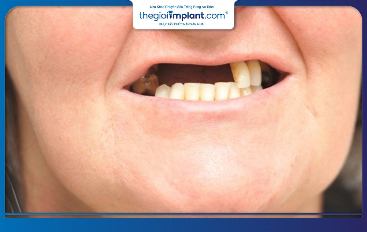 Trường hợp bị tiêu xương hàm có thể phải ghép xương trước khi trồng răng