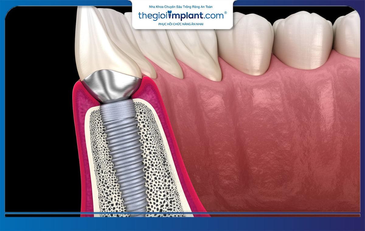Implant bị đào thải