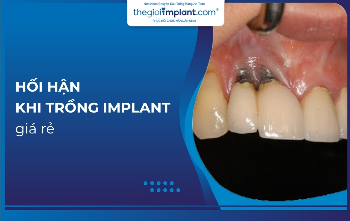 Hối hận khi trồng Implant với mức giá quá rẻ