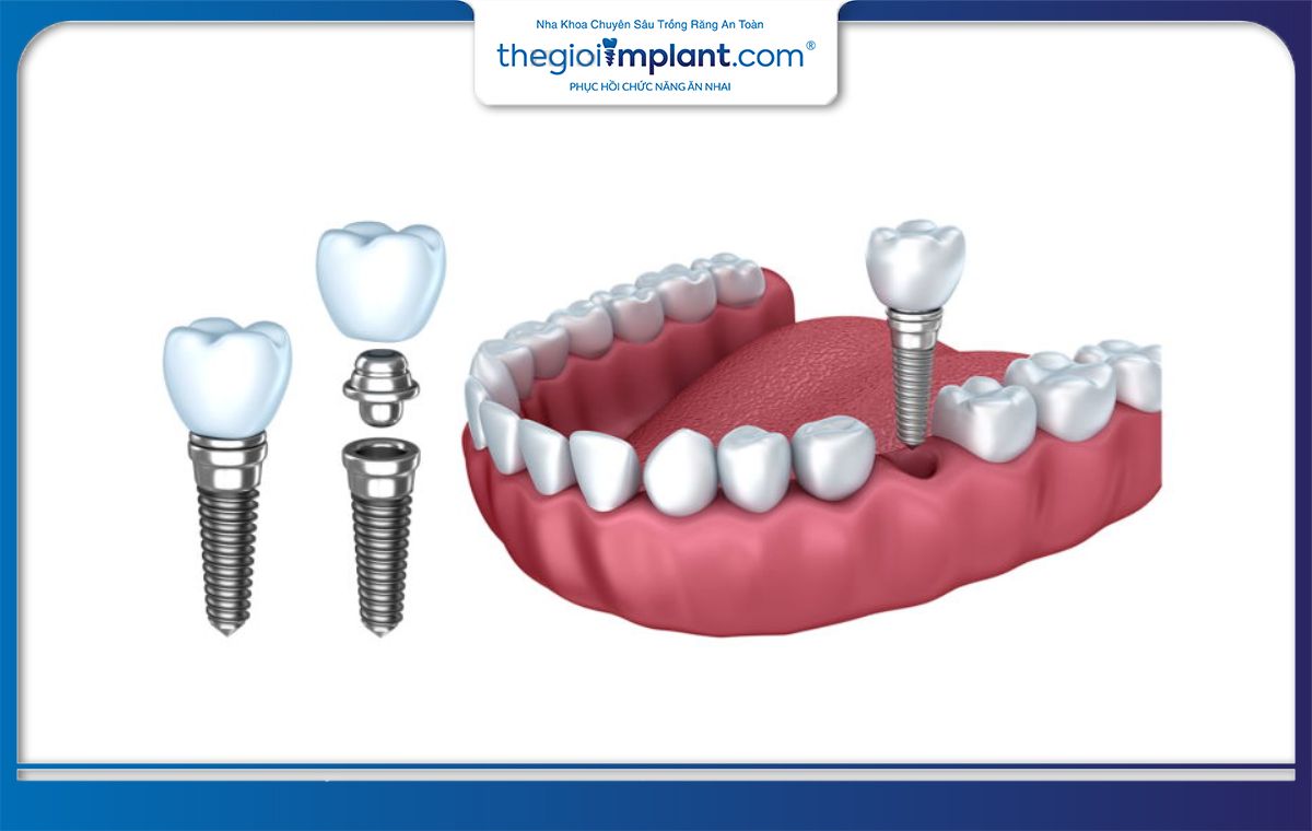 Cấu tạo của một chiếc răng Implant