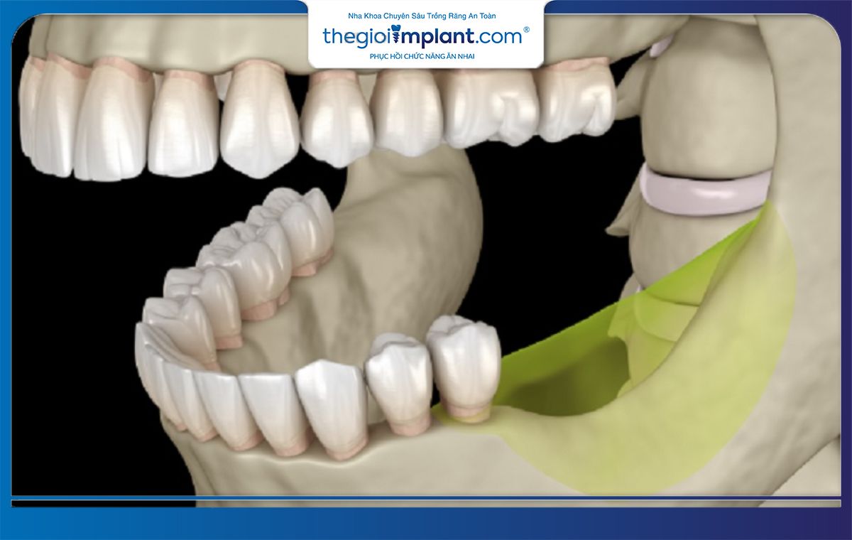 Người có cấu trúc xương hàm không đầy đủ không nên trồng răng Implant