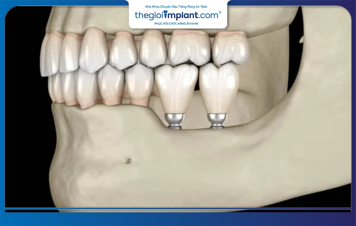 Lợi ích của trồng răng Implant là ngăn chặn tình trạng tiêu xương hàm