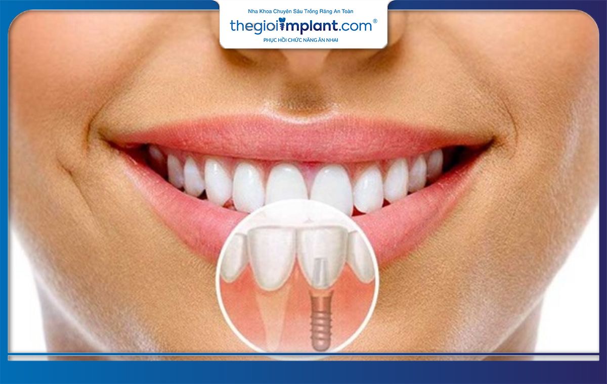 Răng Implant có độ thẩm mỹ tương đương răng thật